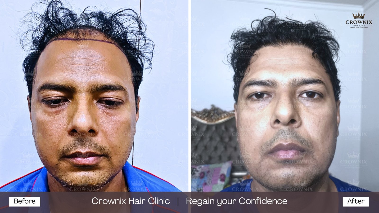 Hair transplant before and after result at Crownix Hair Clinic