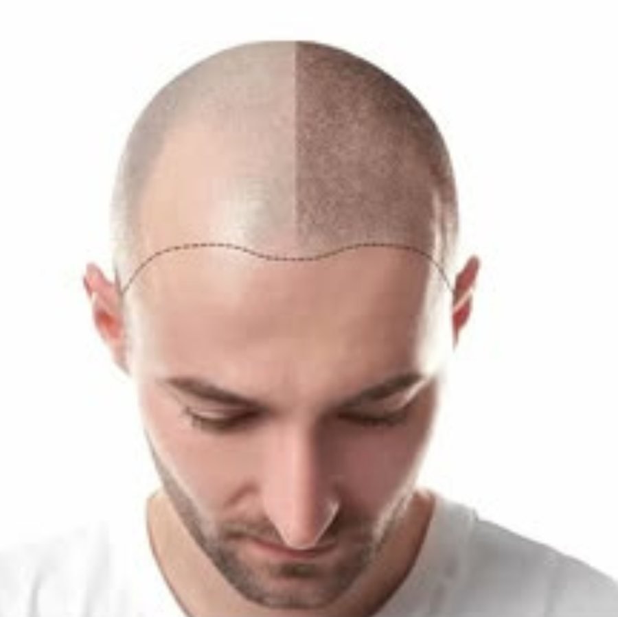 Donor and recipient zones marked ahead of a hair transplant procedure