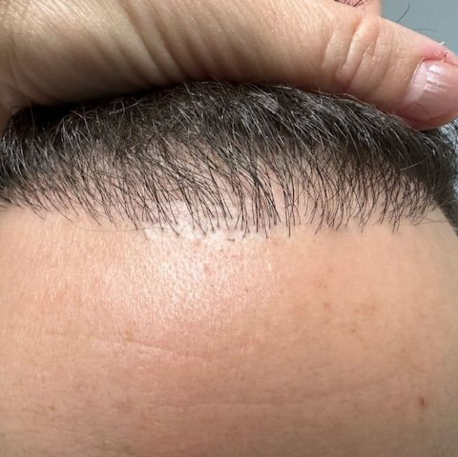 Close-up of a natural, healed hairline after FUE treatment