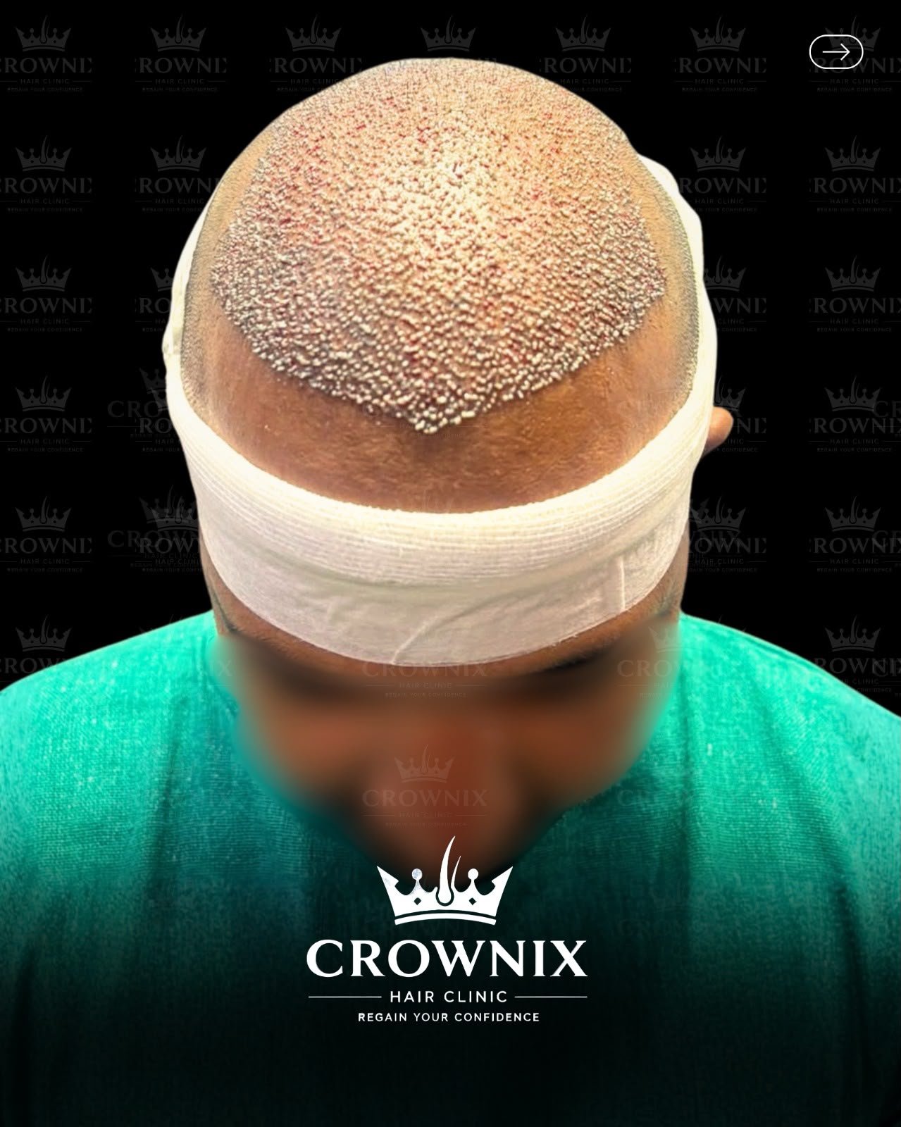 Crownix patient transplant result