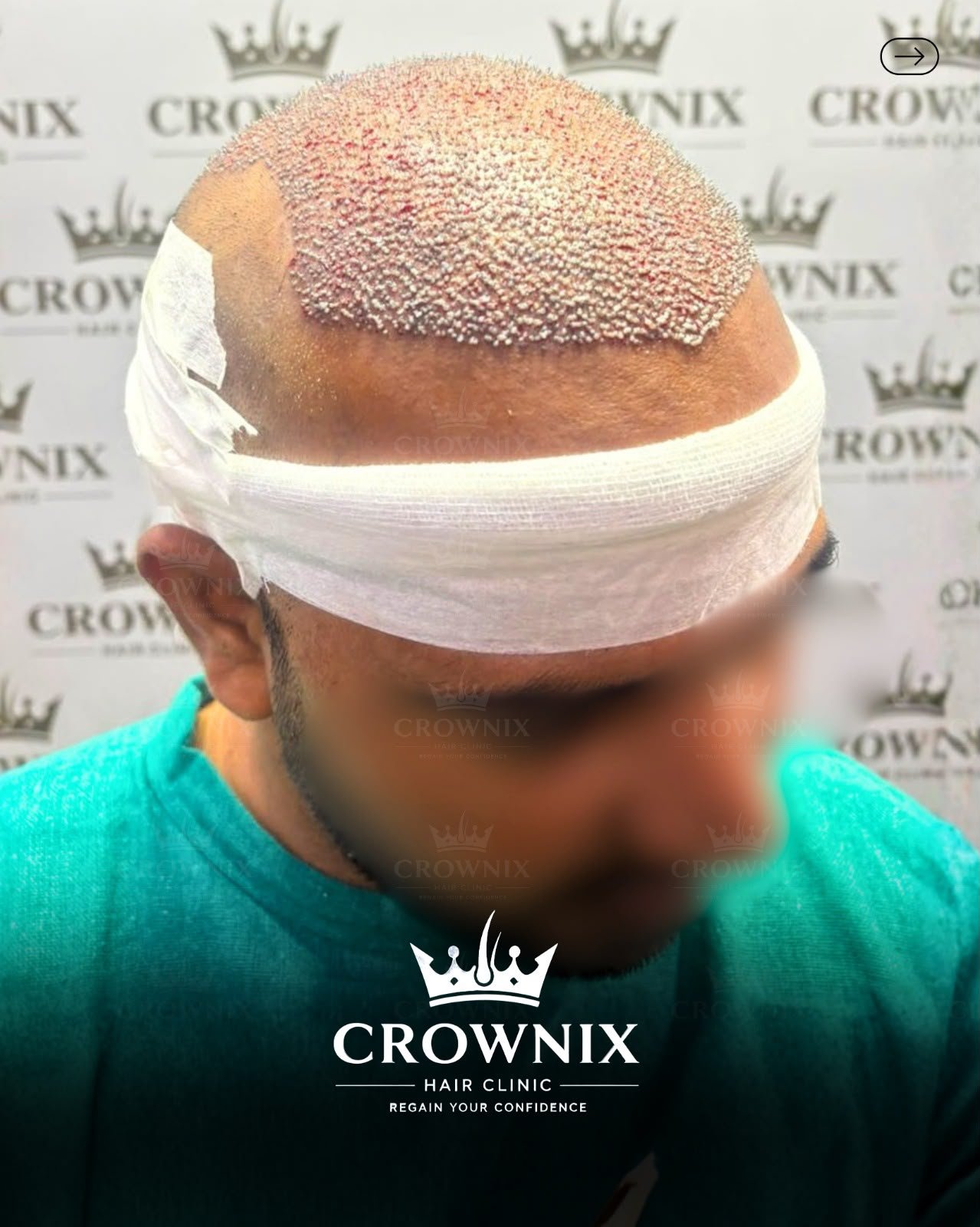 Crownix patient transplant result from an angled view
