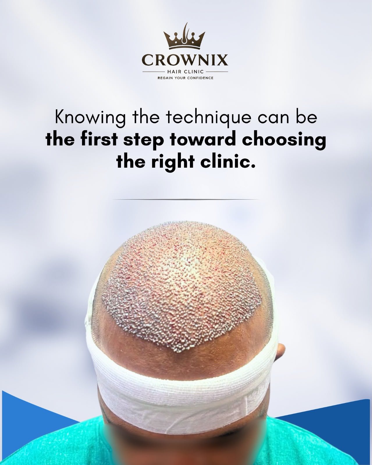 Crownix patient hairline after procedure