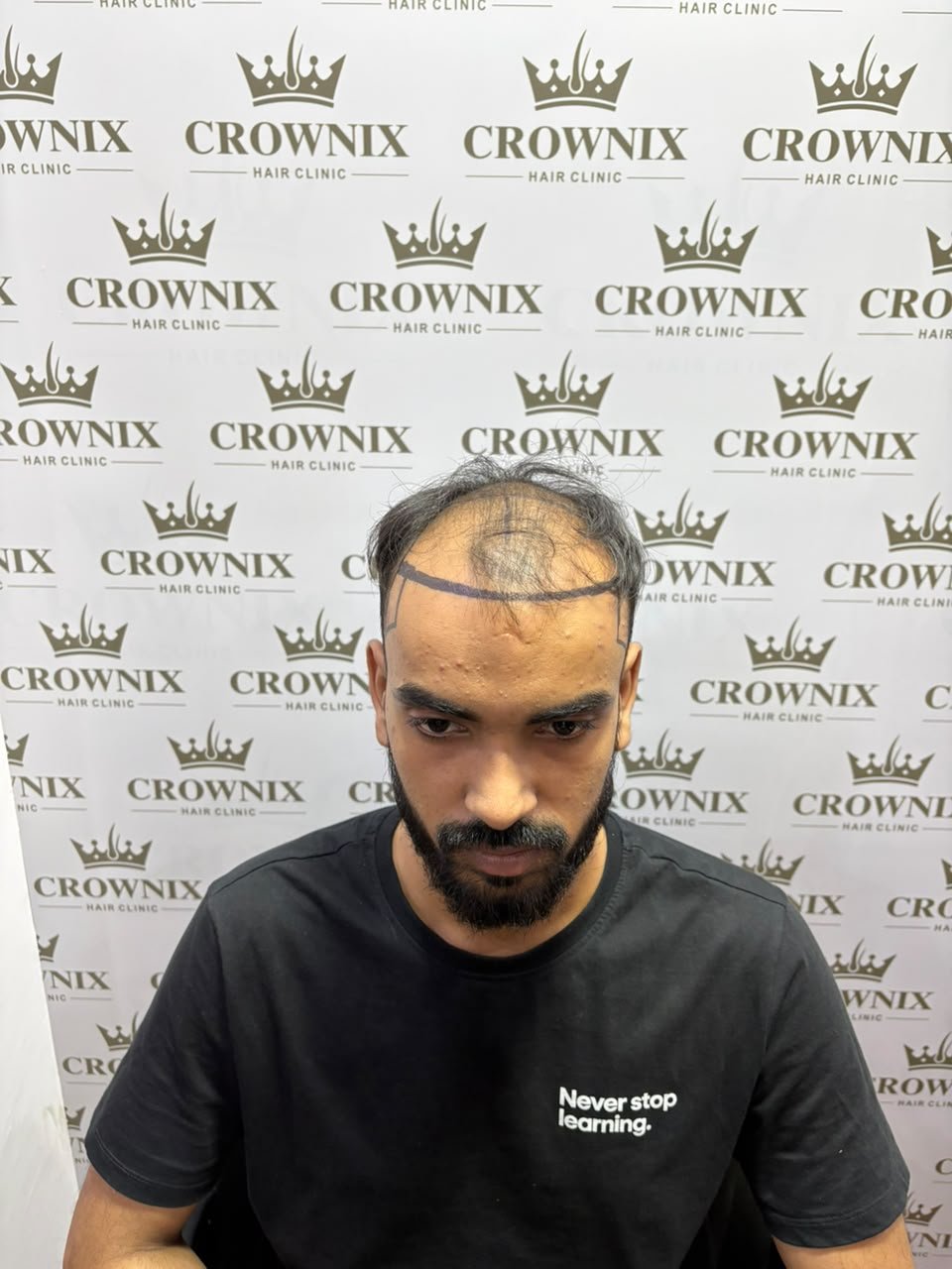 Crownix patient before hair transplant