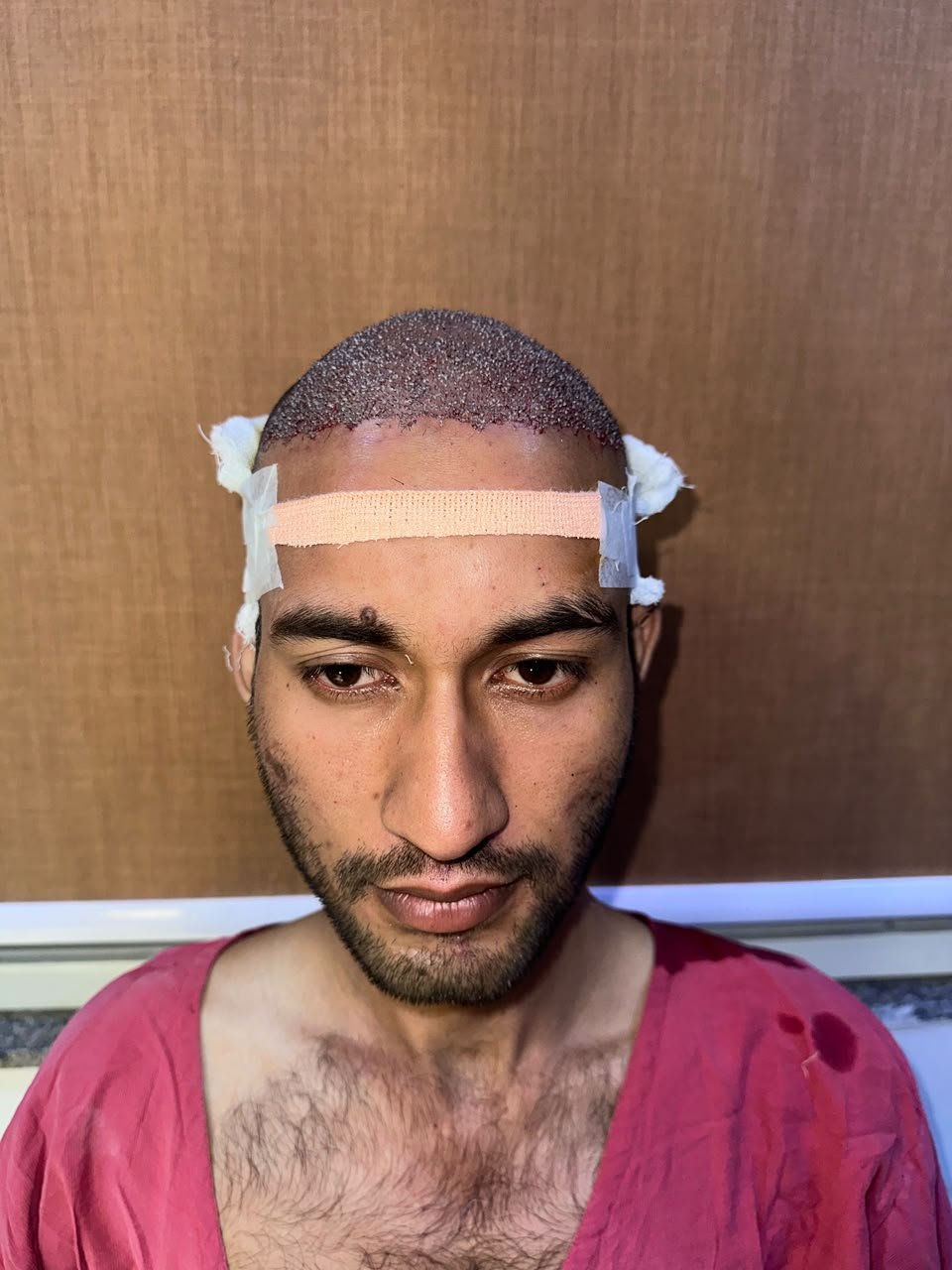 Crownix patient after hair transplant