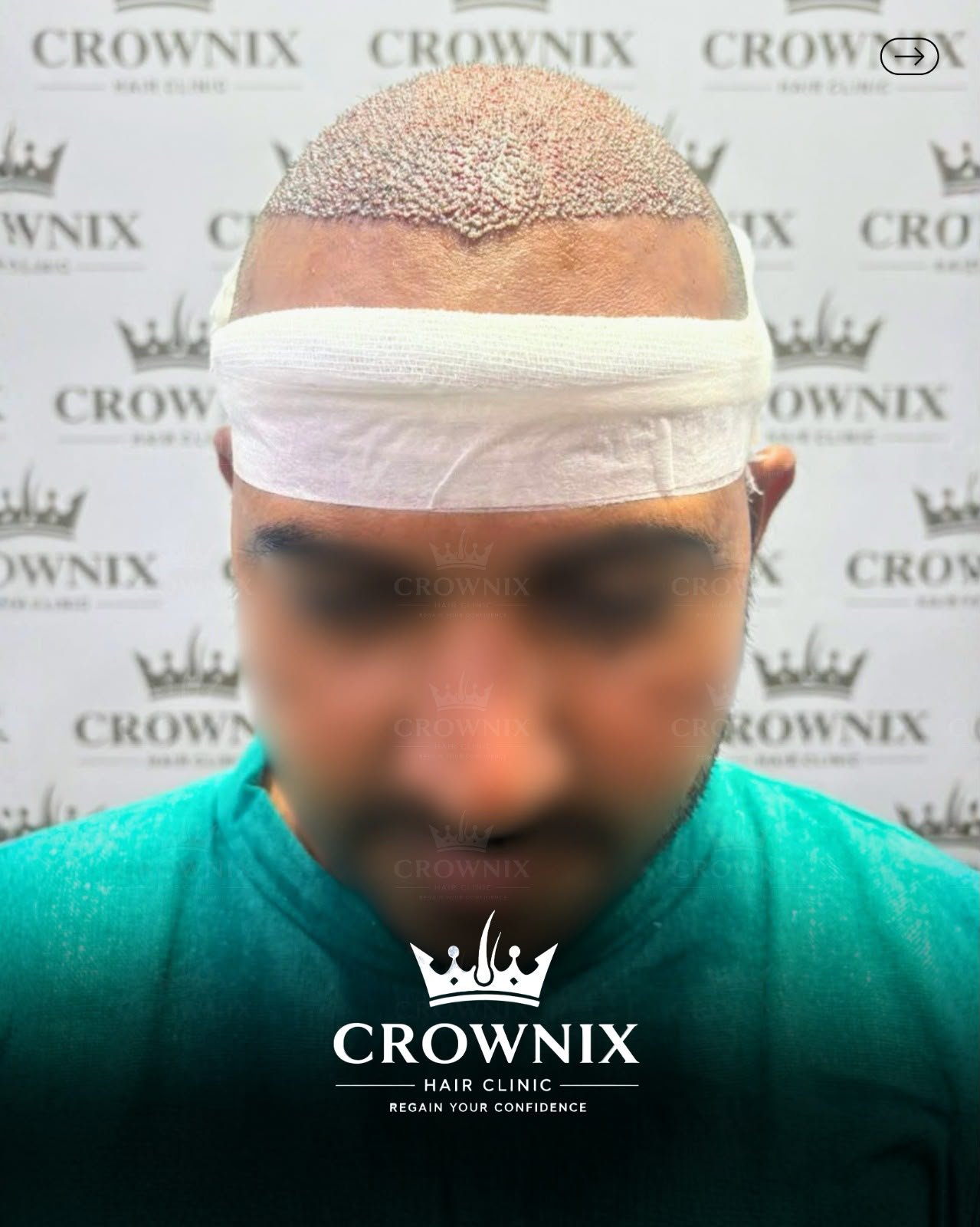 Crownix patient hairline planning