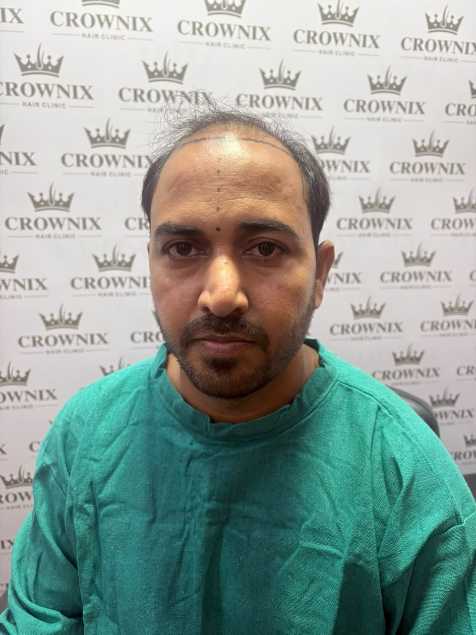 Crownix patient scalp assessment
