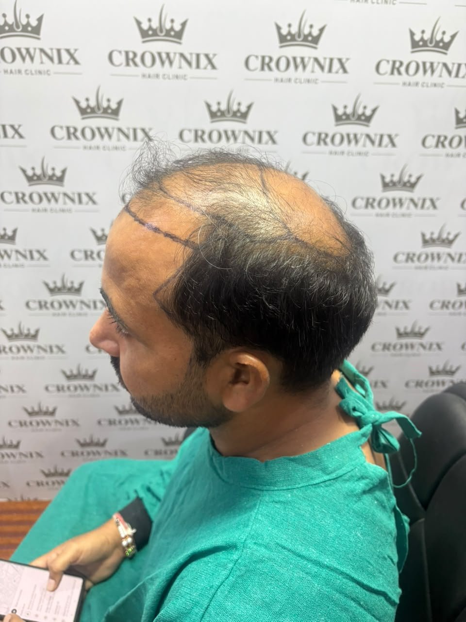 Crownix patient hair transplant planning