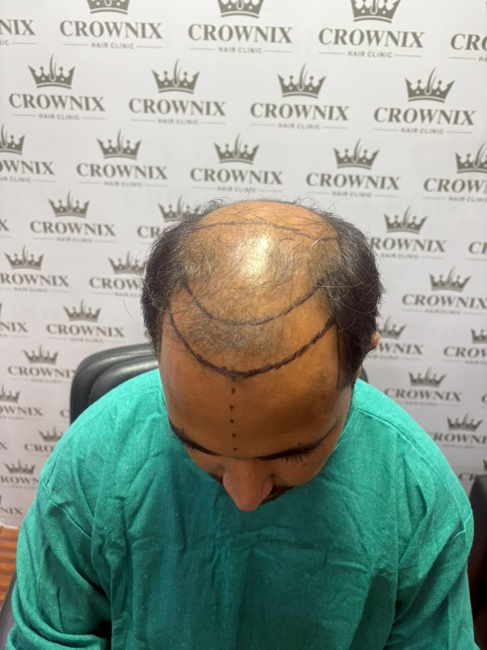 Crownix patient post-transplant photograph