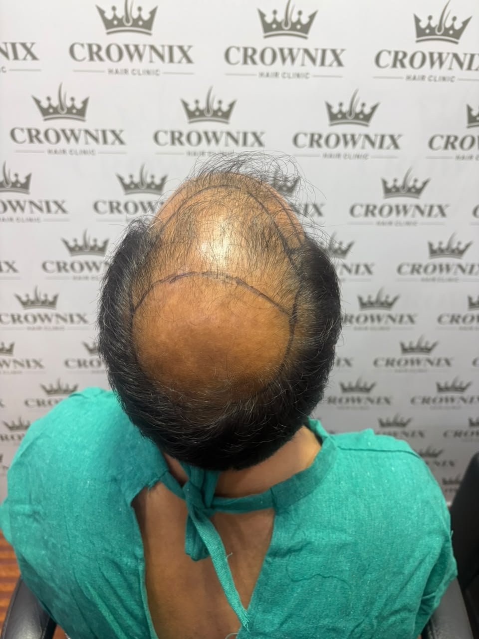 Crownix patient hair transplant follow-up